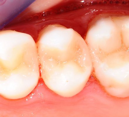 amalgamske-bele-zalivke-4 amalgamske-bele-zalivke-4