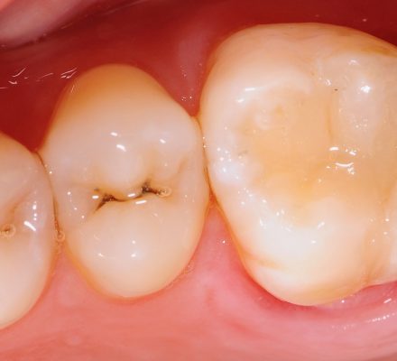 amalgamske-bele-zalivke-6 amalgamske-bele-zalivke-6