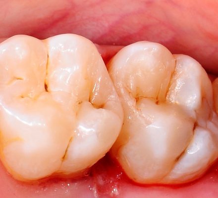 bele-zalivke bele-zalivke