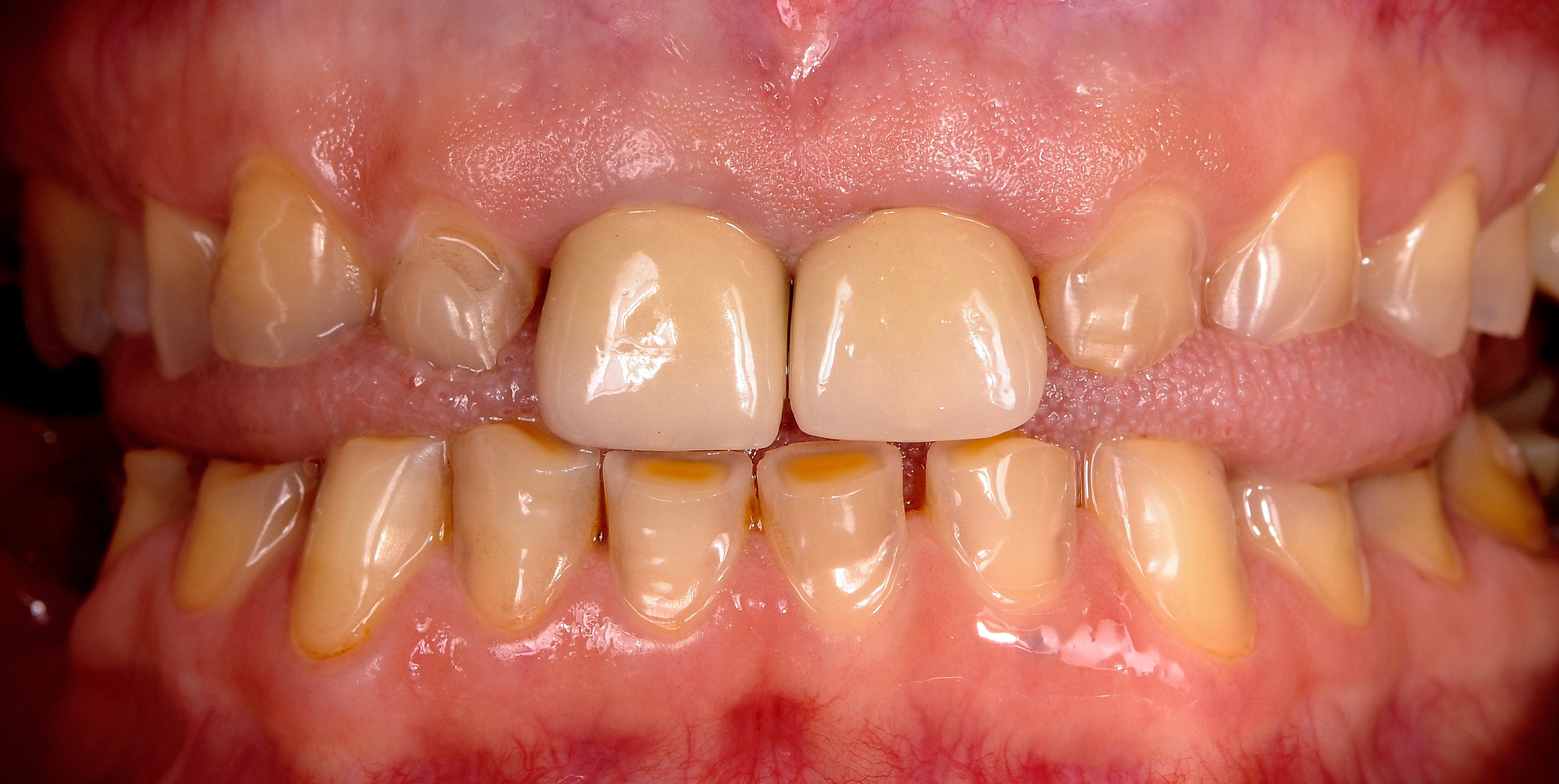 Zobne prevleke stanje pred posegom