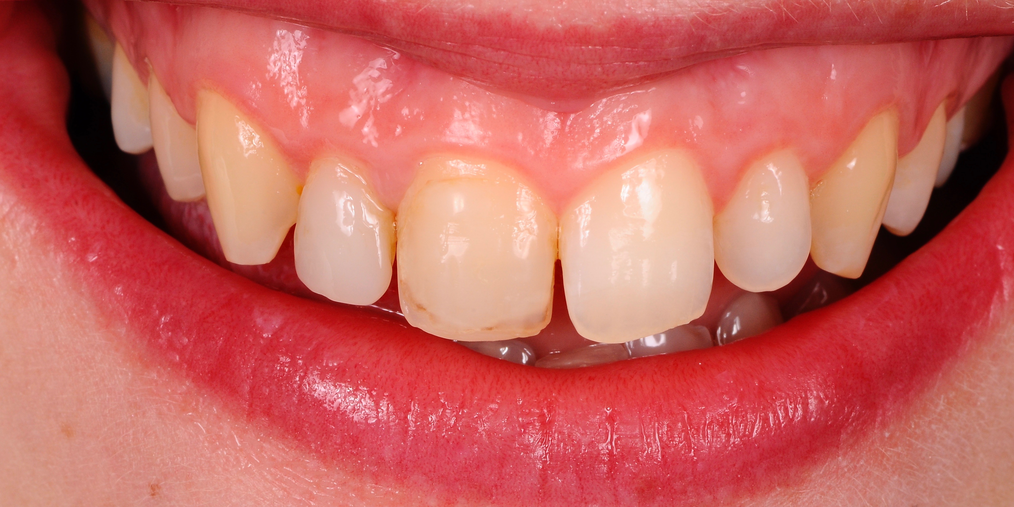 Zobne luske stanje pred posegom