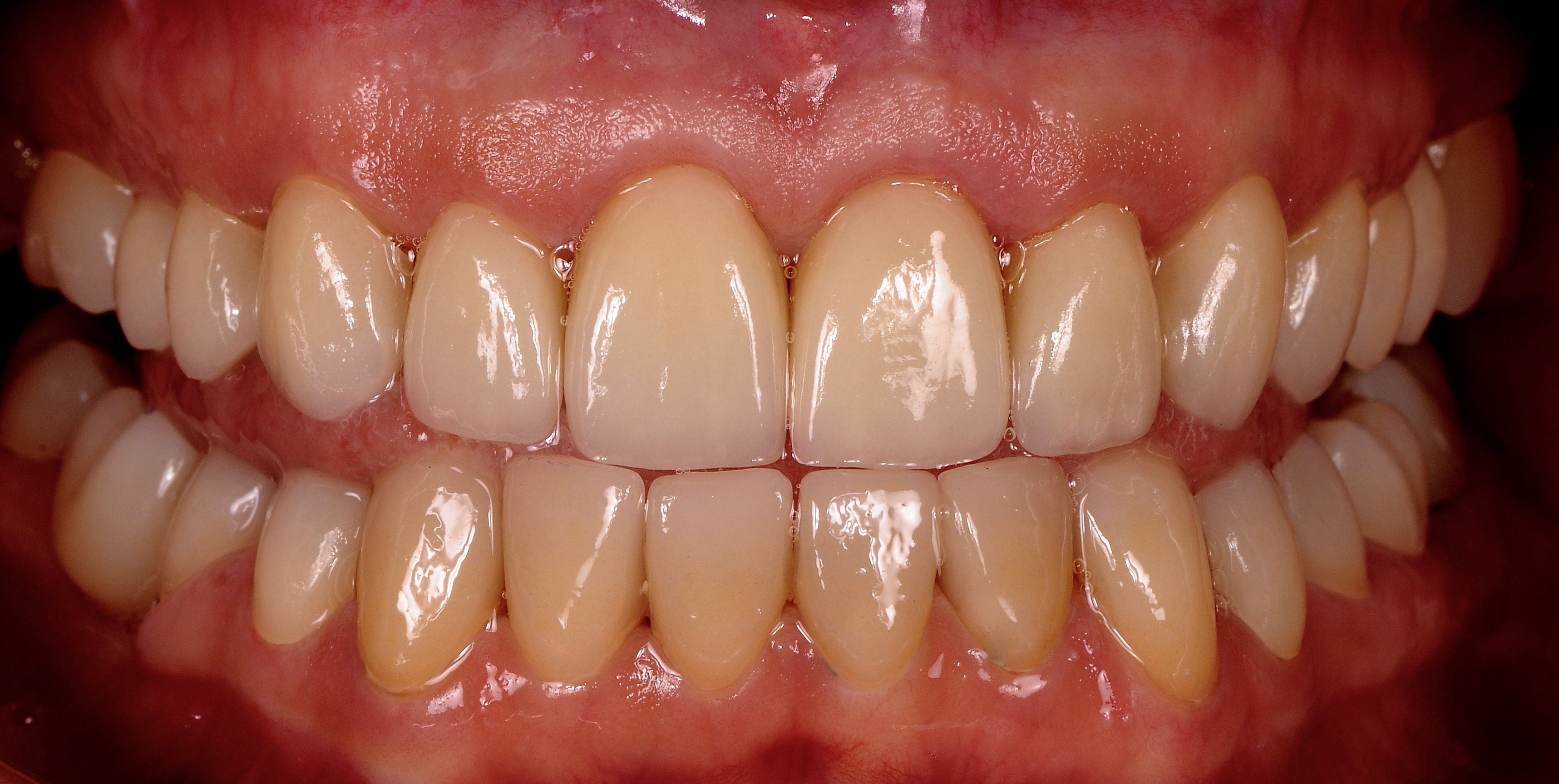 Zobne prevleke stanje po posegu