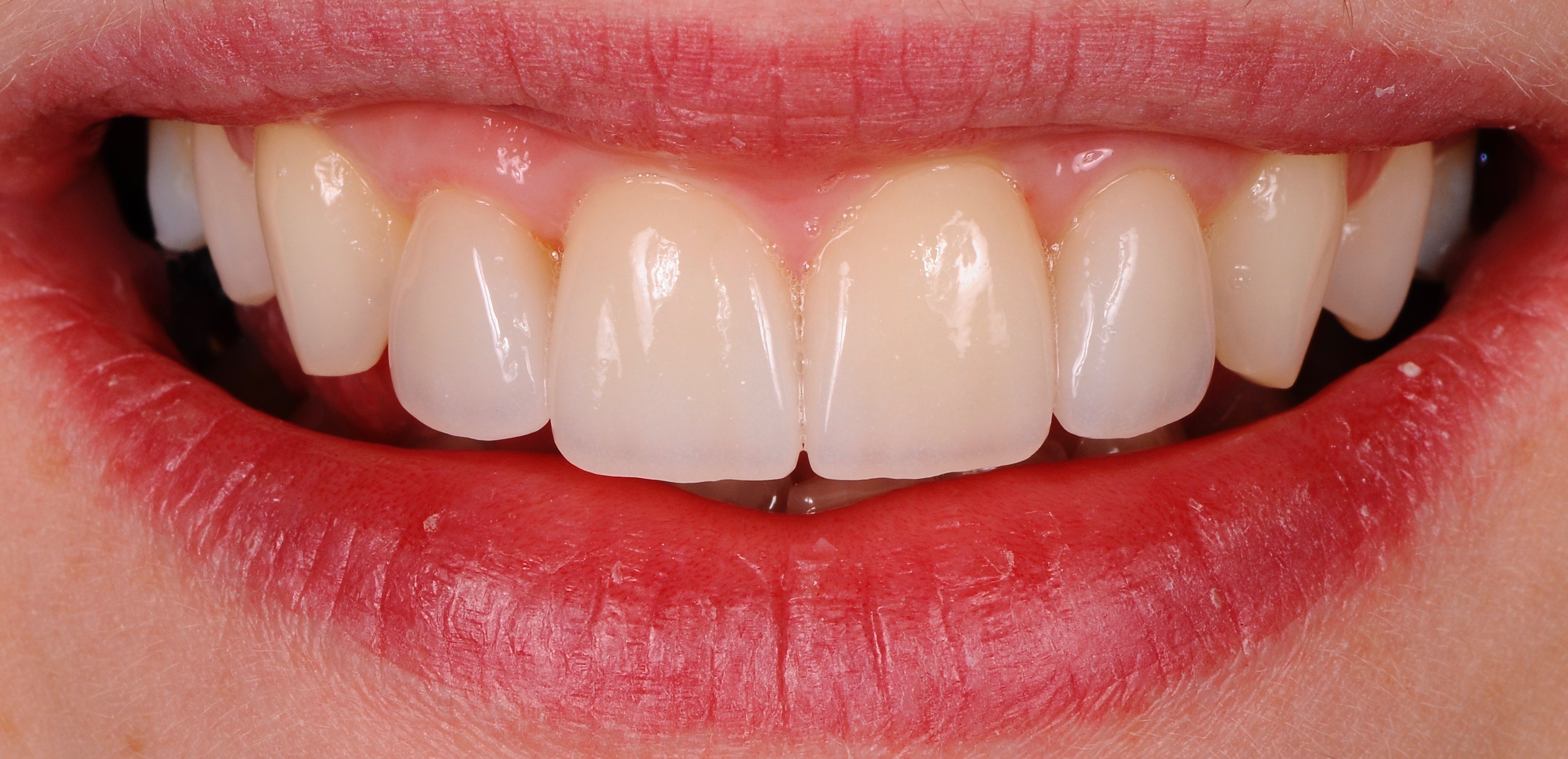 Zobne luske stanje po posegu