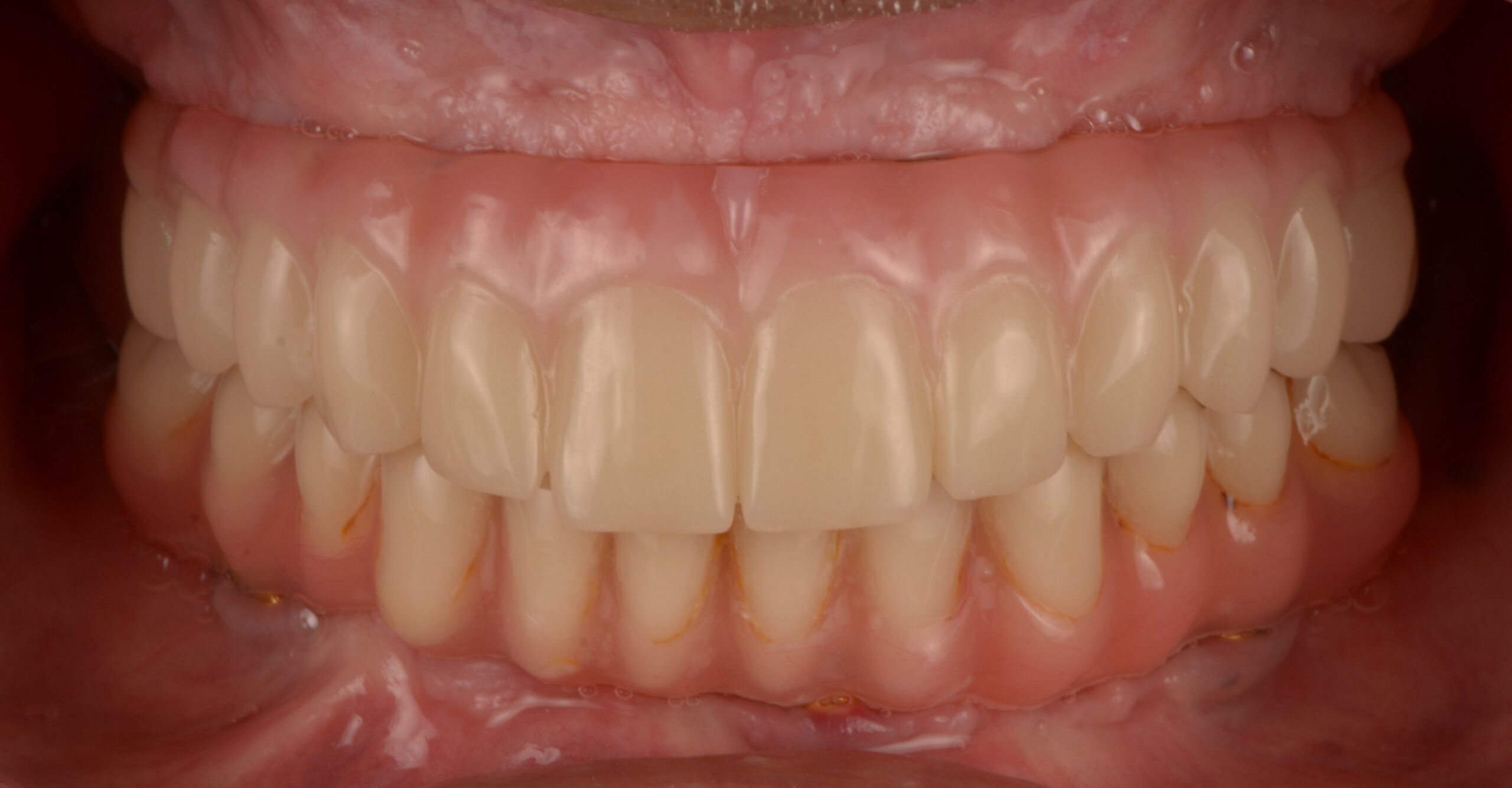 Stanje po posegu All on 4