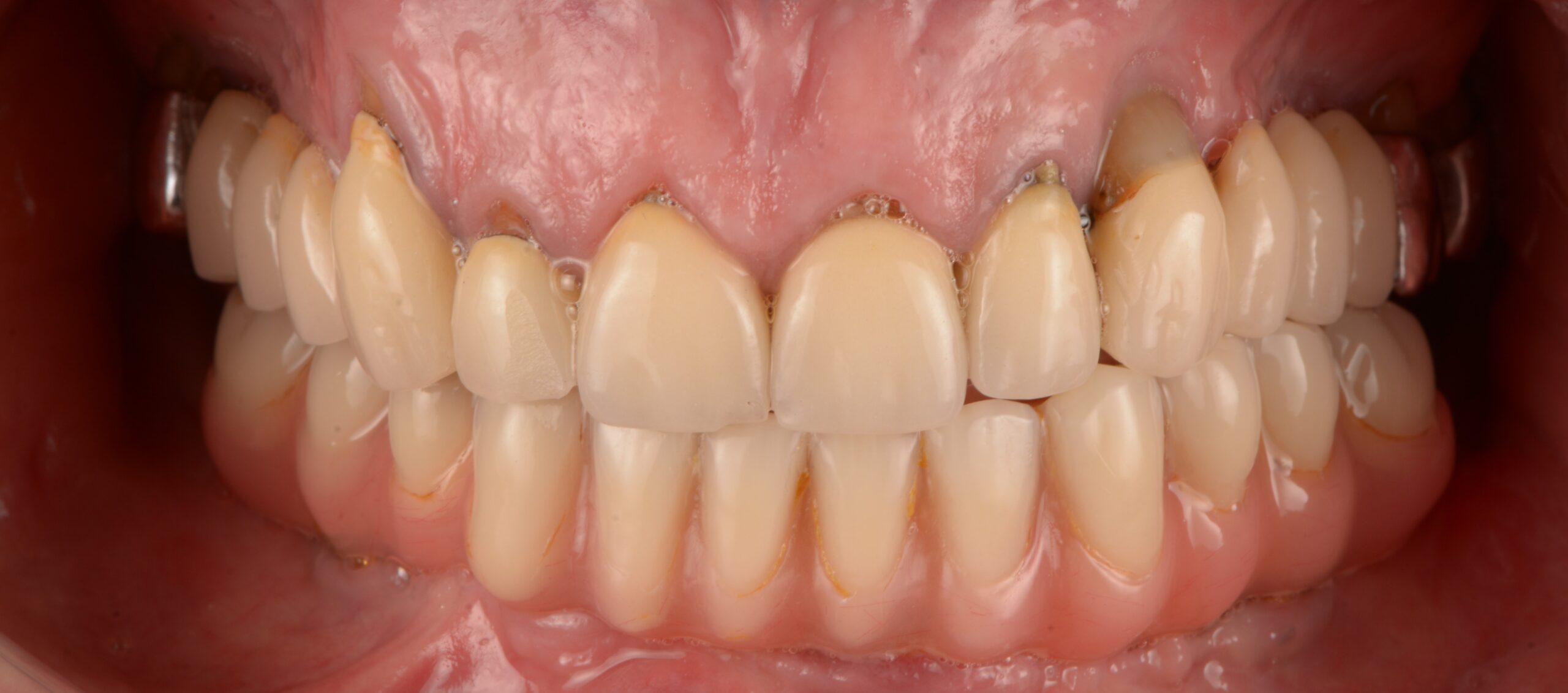 All on 4 pred posegom